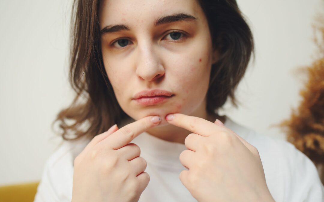 Why Your Acne Keeps Coming Back (and Why It May Not Be Just a Skin Problem)