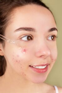 Close up of adult woman treating her acne with natural products