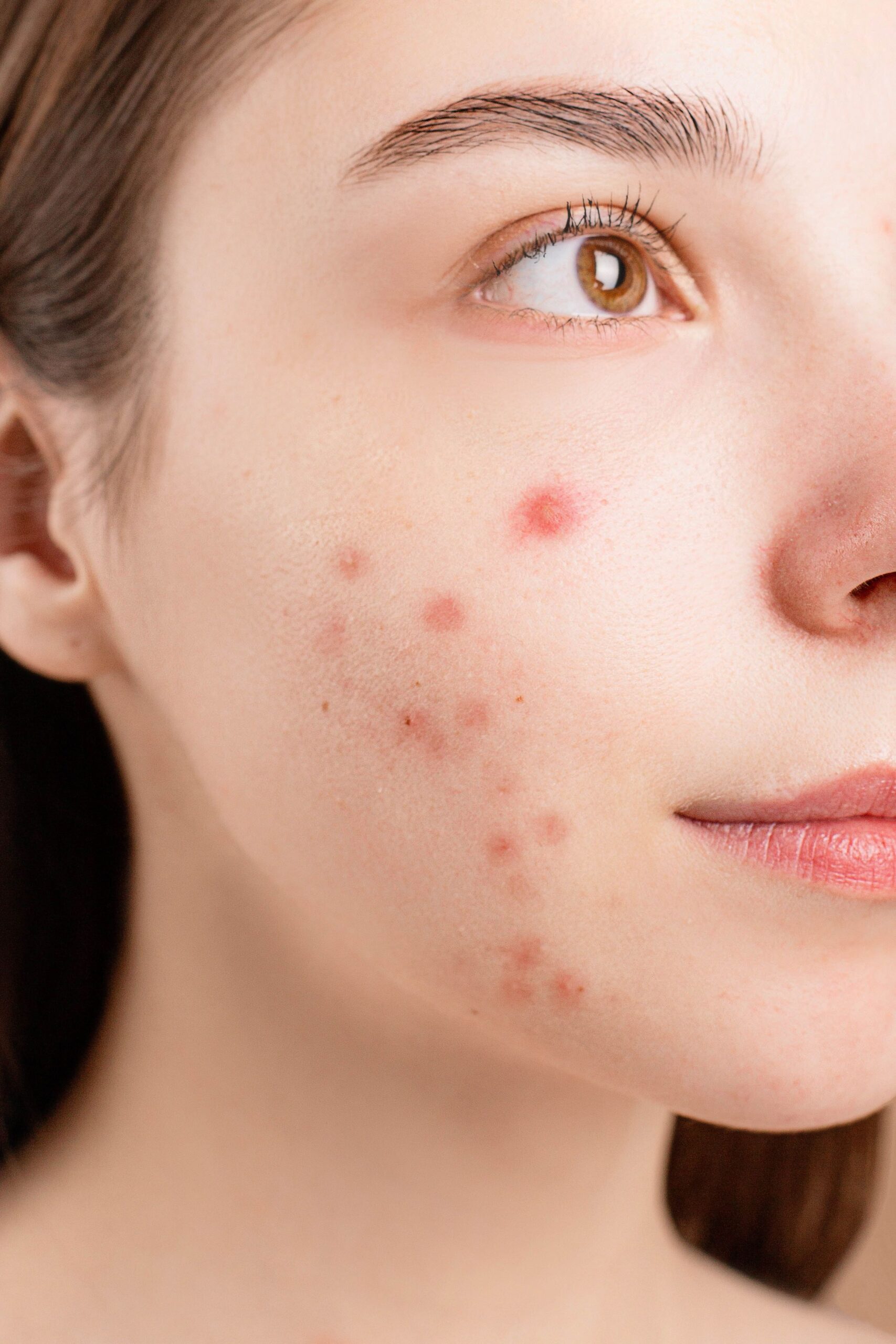 Close up of adult woman with acne Close up of adult woman with acne